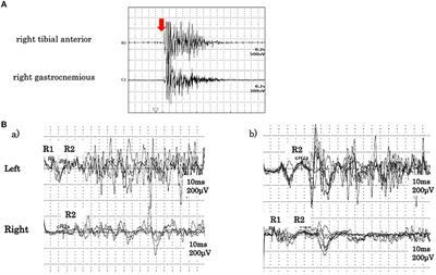 Anti-glycine receptor antibody-positive progressive encephalomyelitis with rigidity and myoclonus initially presenting with one-sided stiff face: A case report